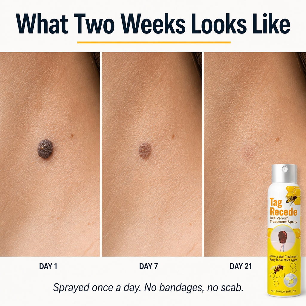VenomaSilk | Éliminez facilement les verrues tenaces avec un spray au venin d’abeille et à l’acide salicylique | elesira