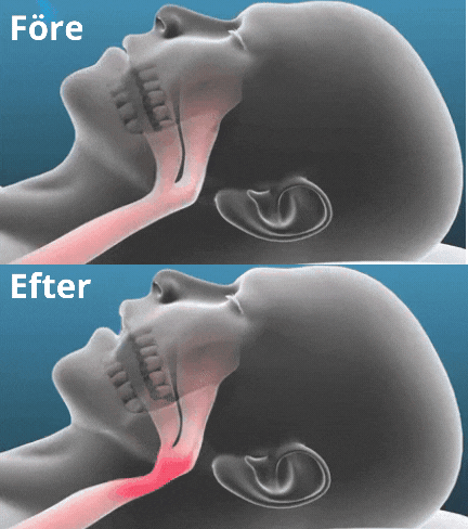 SnoreEase | Silence Snoring Instantly for Energized, Peaceful Mornings | elesira