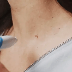 Conjunto para remover sinais cutâneos - Recupere facilmente uma pele suave