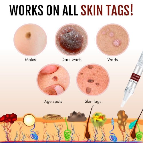 Removedor de verrugas - caneta de precisão para acrocórdons - fórmula herbal secante | elesira