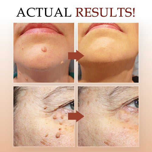 Removedor de verrugas - caneta de precisão para acrocórdons - fórmula herbal secante | elesira