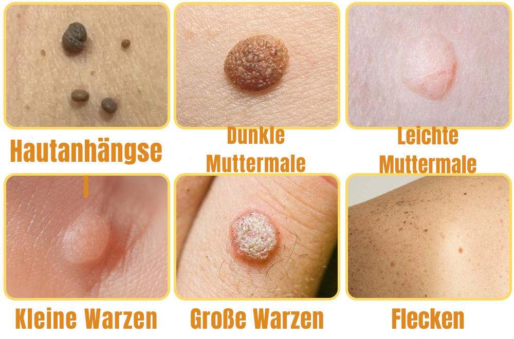 Wart Removal Spray with Bee Venom Formula - Pain-Free Solution | elesira